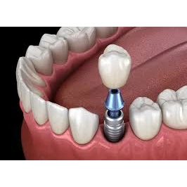 IMPLANTS