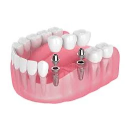 IMPLANTS