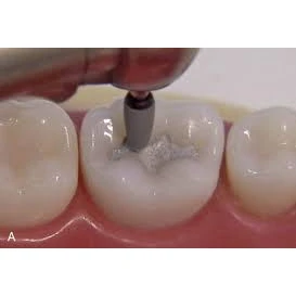 CONSERVATIVE AND ENDODONTIC TREATMENT