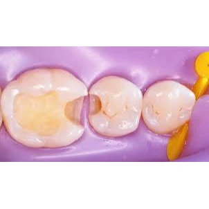 CONSERVATIVE AND ENDODONTIC TREATMENT