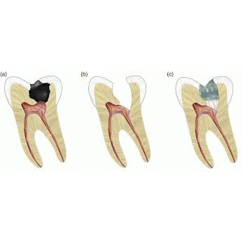 CONSERVATIVE AND ENDODONTIC TREATMENT