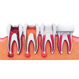 CONSERVATIVE AND ENDODONTIC TREATMENT