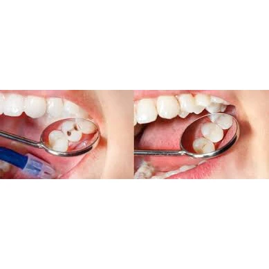 CONSERVATIVE AND ENDODONTIC TREATMENT