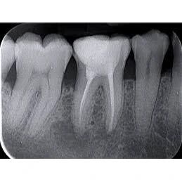 CONSERVATIVE AND ENDODONTIC TREATMENT