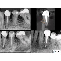CONSERVATIVE AND ENDODONTIC TREATMENT